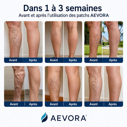 Patchs Veineux AEVORA® — Soulagez vos jambes sans crème, sans collant, sans chirurgie